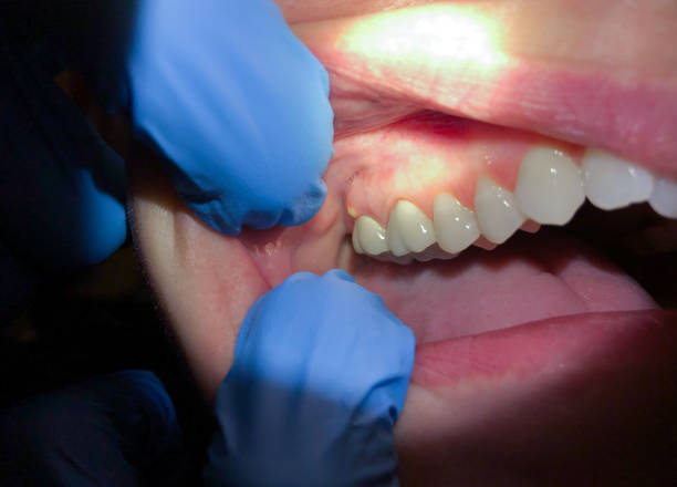 Best Broken or Chipped Tooth Repair in Columbus, GA