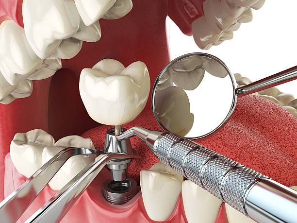 Best Emergency Denture Repair in Columbus, GA